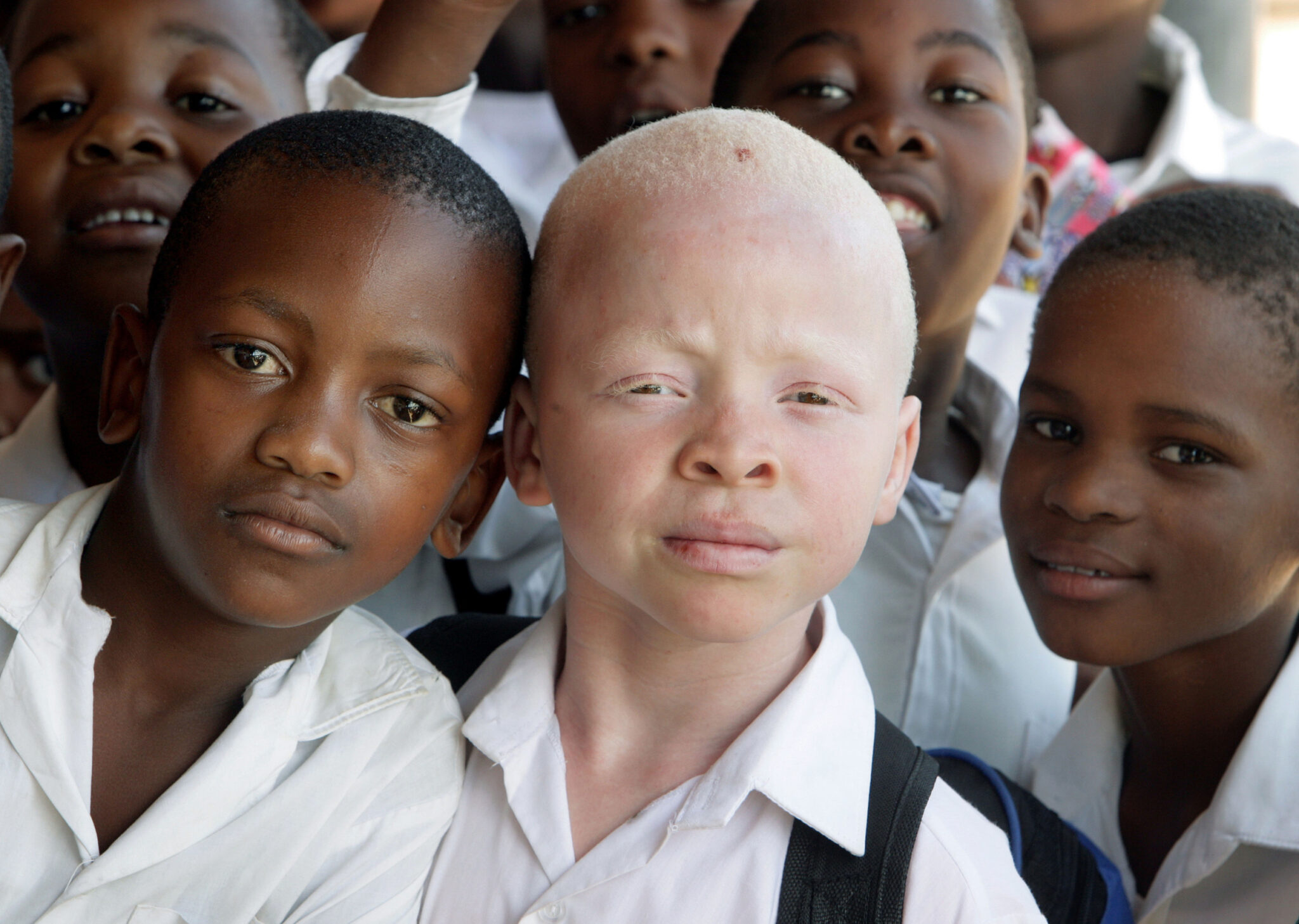 Чернокожий африканец. Альбинос негроидной расы. Люди разных рас.